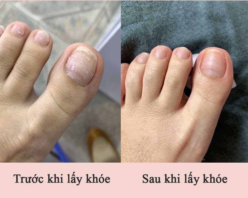 cây lấy khóe móng cán gỗ chuyên dùng nail