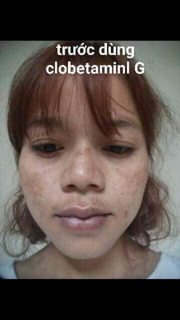 Kem trị nám Thái Lan