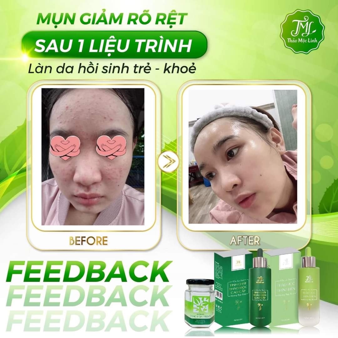 Bột rửa mặt đông y thảo mộc linh kiềm nhờn