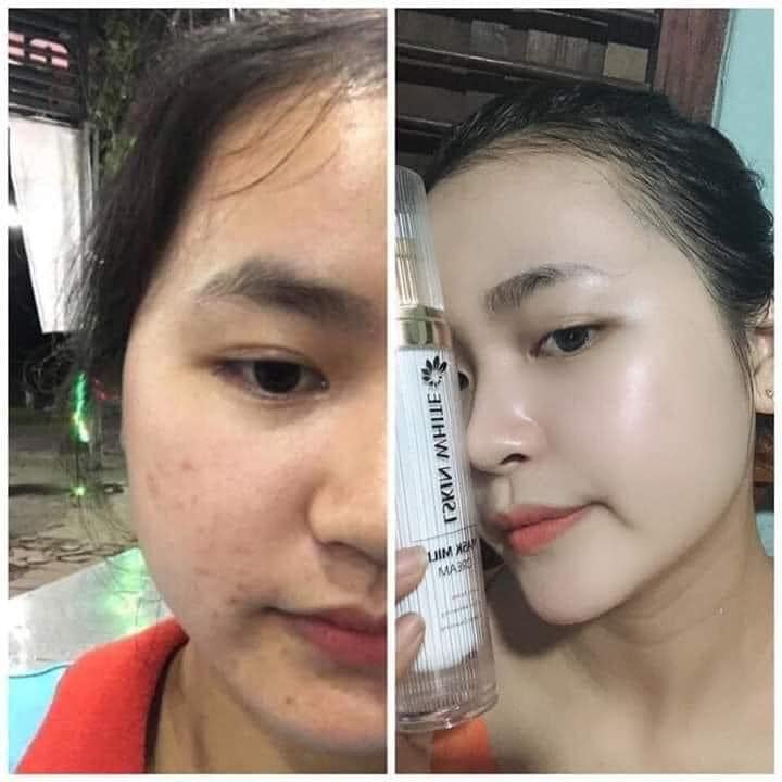 Ủ KÉN TẰM - DƯỠNG TRẮNG LÀM ĐỀU MÀU DA
