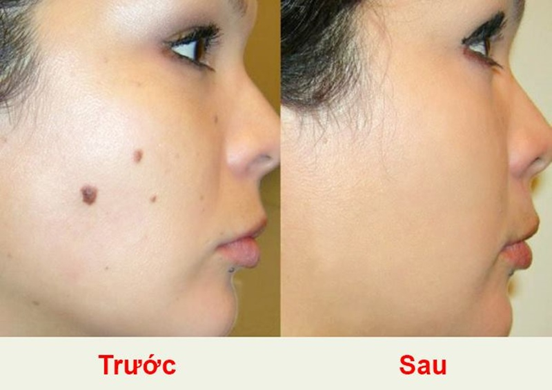 Gel Xóa Nốt Ruồi Tàn Nhang Nga 3ml