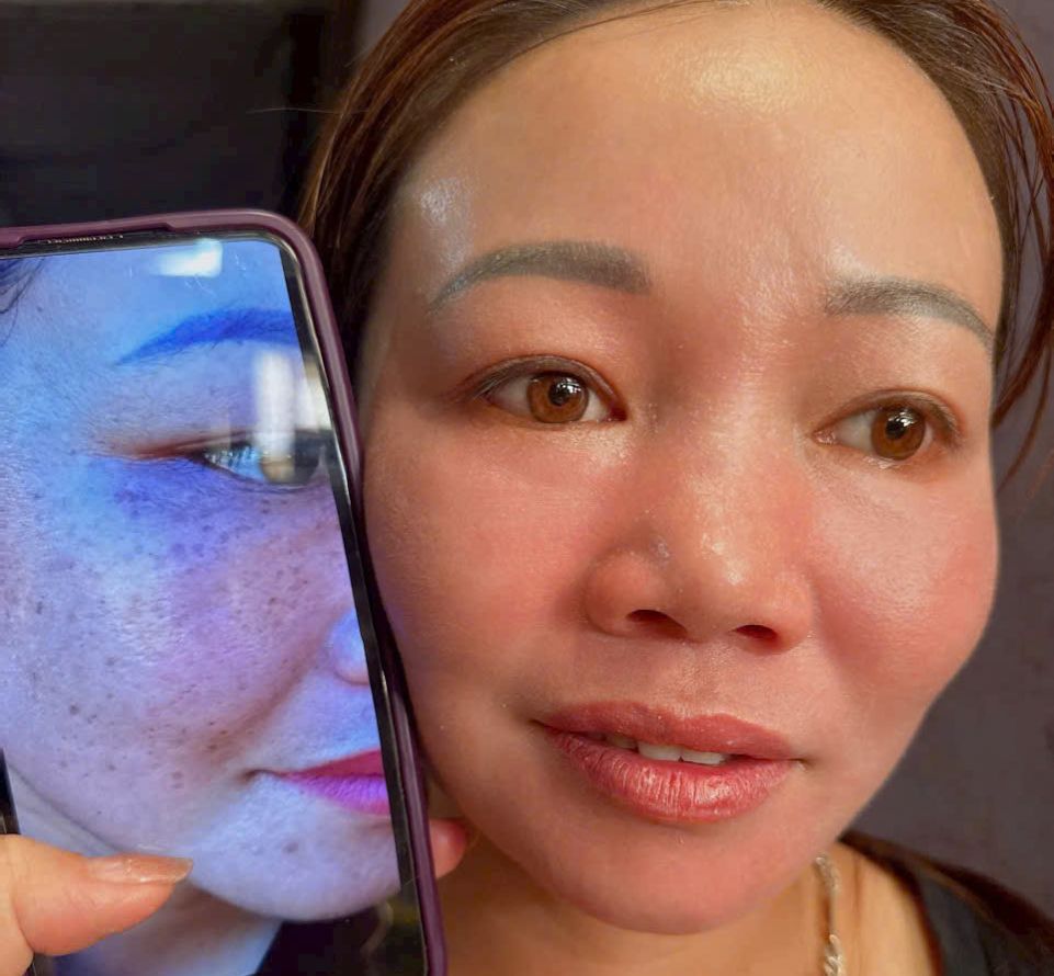 [Genuine] Yody Phuong Anh Skin Peeling Treatment Helps Even Skin Tone
