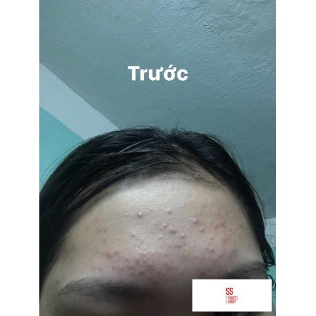 Kem làm giảm mụn Shiseido pimplit Nhật Bản