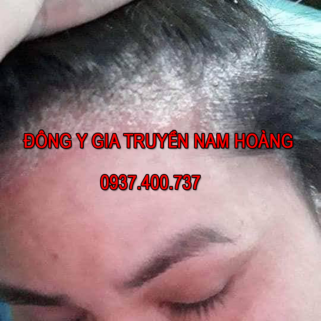 Dược Phẩm Đặc Trị Bệnh Nấm Da Đầu Nam Hoàng