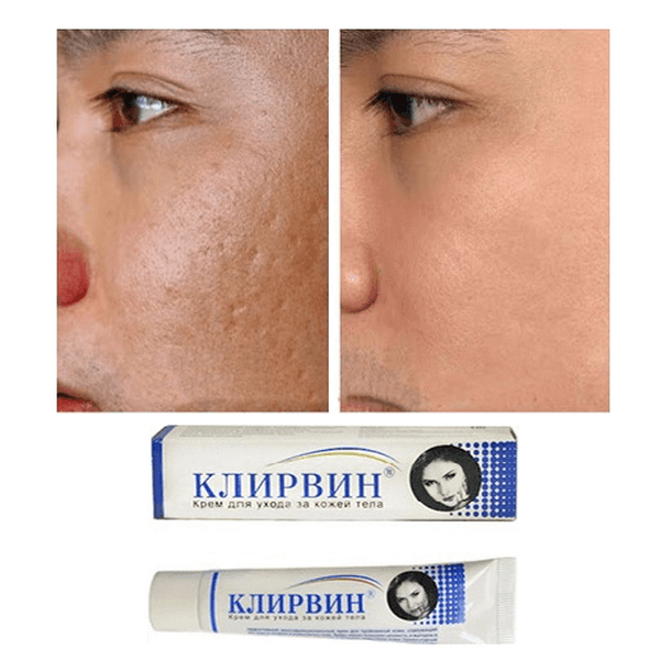 Kem mờ sẹo Nga Klirvin 25g mờ sẹo, mờ rạn da