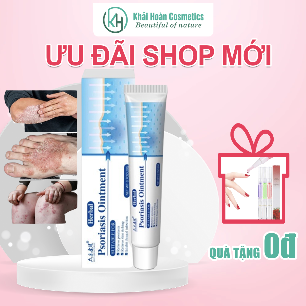 Kem bôi vảy nến á sừng mụn nước Herbal