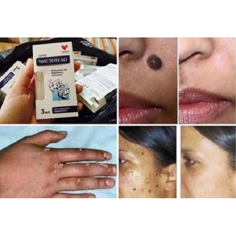 Gel tẩy mục ruồi mục cóc