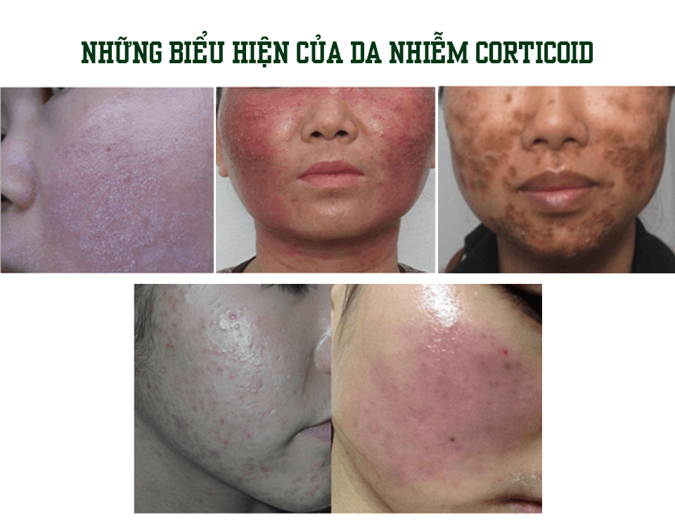 HIAL-DMAE là tinh chất chăm sóc chuyên biệt cho da