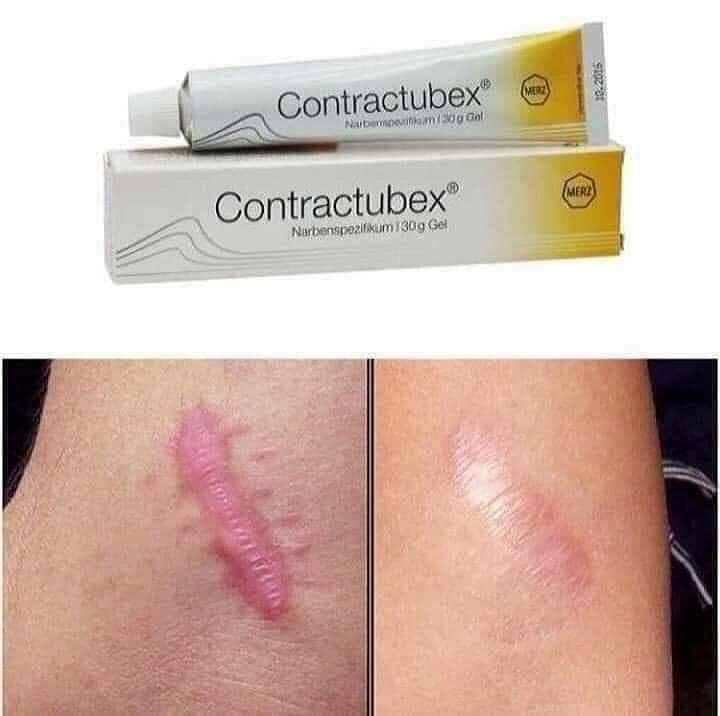 [NỘI ĐỊA ĐỨC] Kem sẹo CONTRACTUBEX 30g