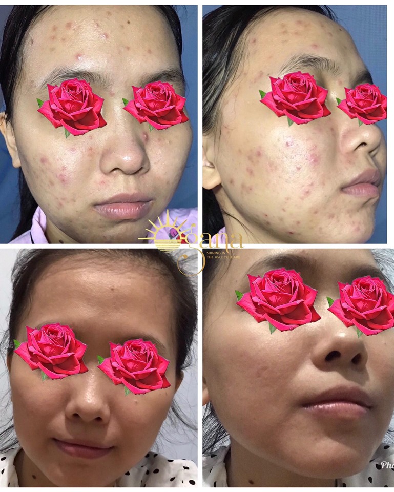 [HCM]SERUM OGANA TRỊ MỤN