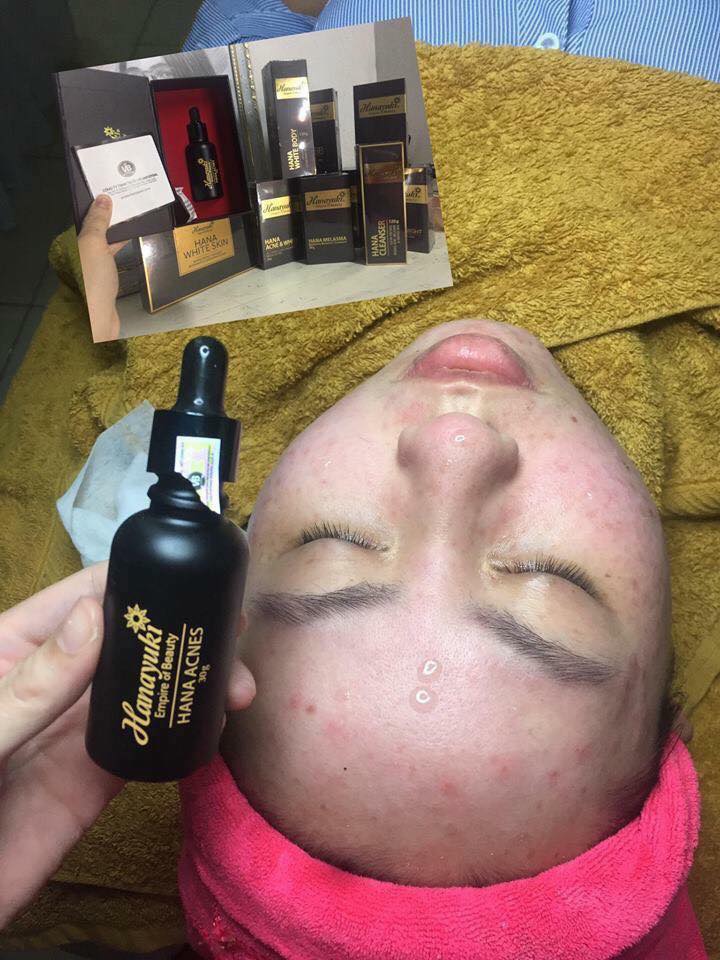Serum Trị Mụn Hanayuki - Hana Acnes