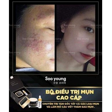 Combo kem face + serum mụn Lục Tảo Soo young (chính hãng)