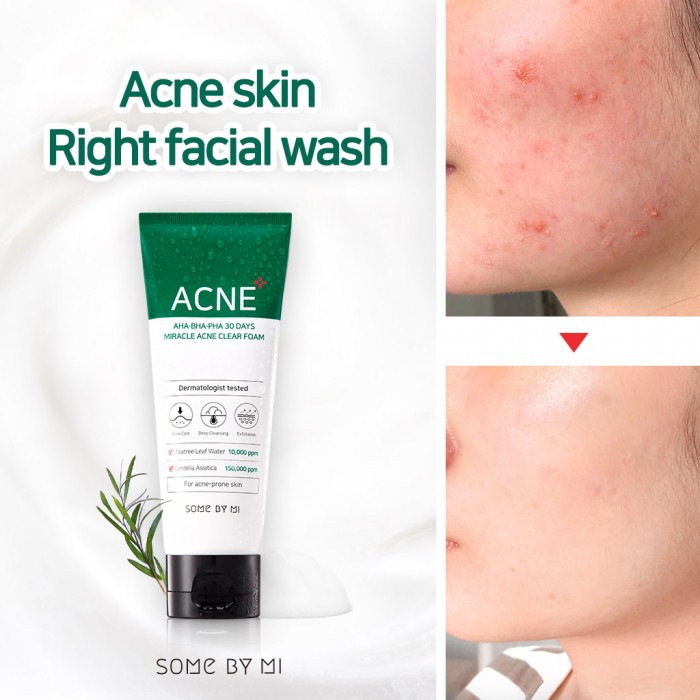 Sữa rửa mặt Some By Mi acne 30days