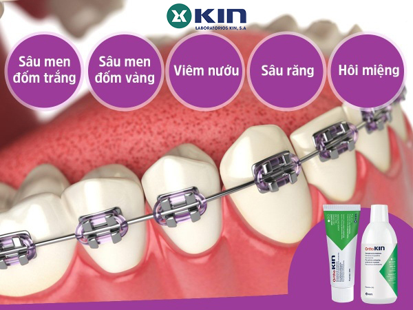Nước Súc Miệng OrthoKin 500ml cho răng niềng