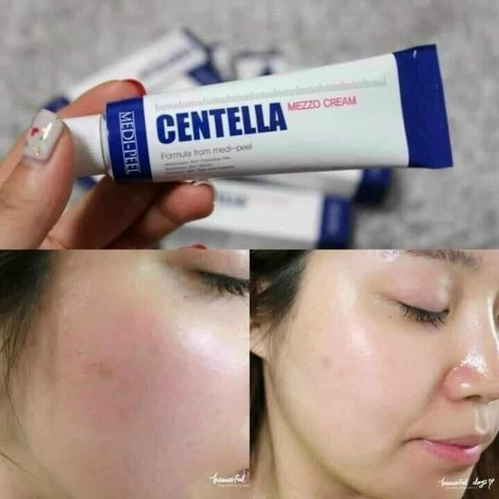 KEM TRỊ, MỤN CENTELLA MEDIPEEL