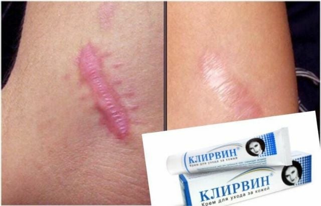 Kem mờ sẹo lồi lõm sẹo thâm Klirvin Nga