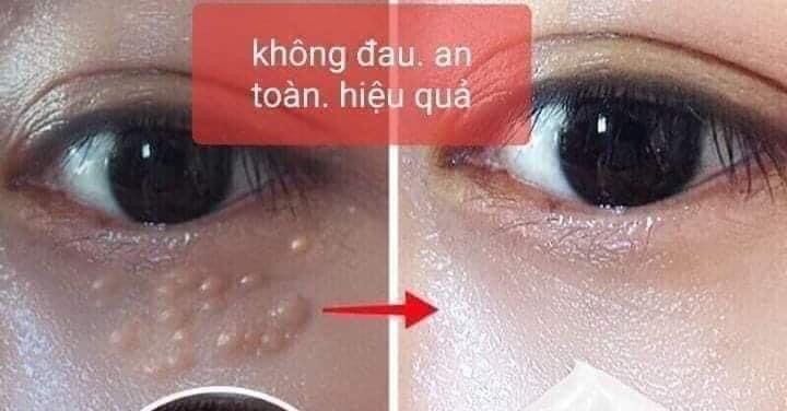 Mụn Thịt Quầng Thâm Nhăn Mẳt