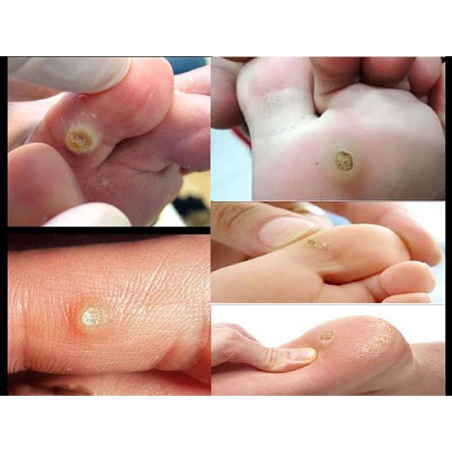 Hộp 6 miếng dán mụn cóc, mắt cá, mụn cơm, vết chai