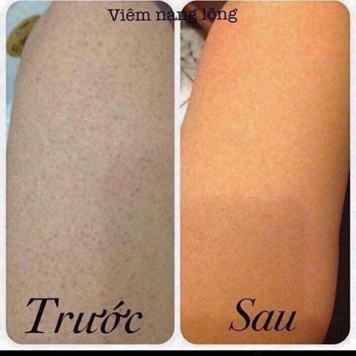 KELA LOTION Bôi Viêm Lỗ Chân Lông Thái Lan
