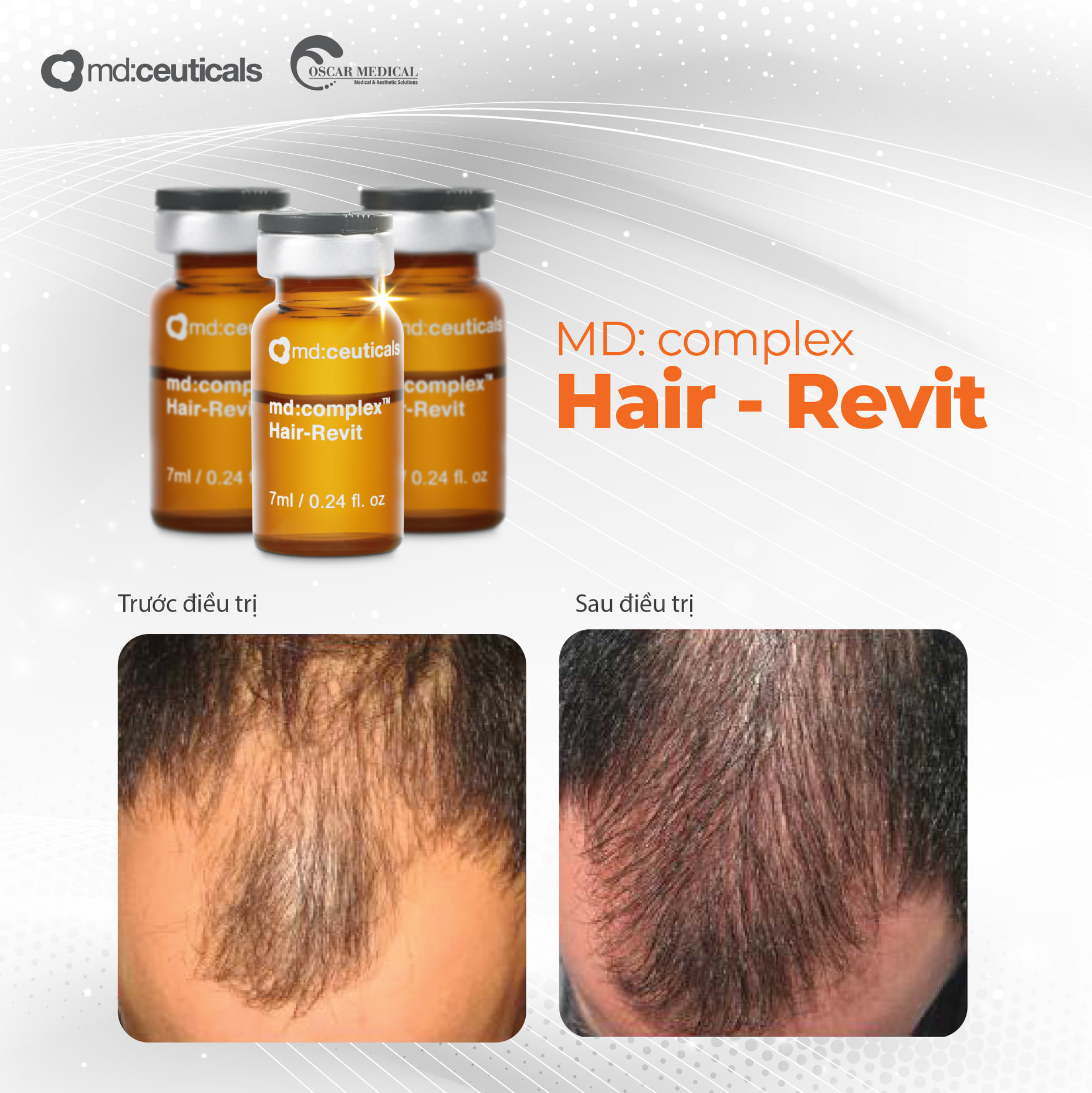 Md:Complex Hair-Revit – Meso MD Ceuticals chống rụng tóc & Kích thích mọc tóc | Meso cosmetic