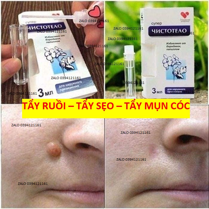 HỘP XÓA NHANH NỐT RUÔI-MỤN COC-SẸO-THỊT THỪA-AN TOÀN NGA SẢN XUẤT-HÀNG CHUẨN CHÍNH HÃNG - TRN 1.2
