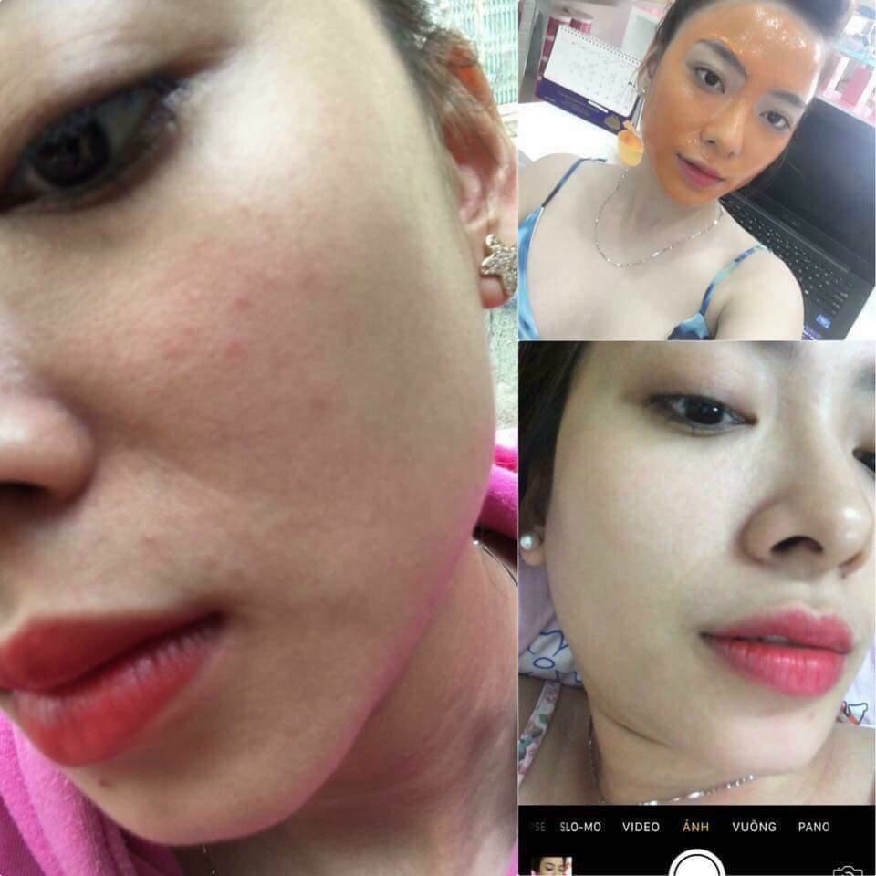 MẶT NẠ BẮC SWHITE