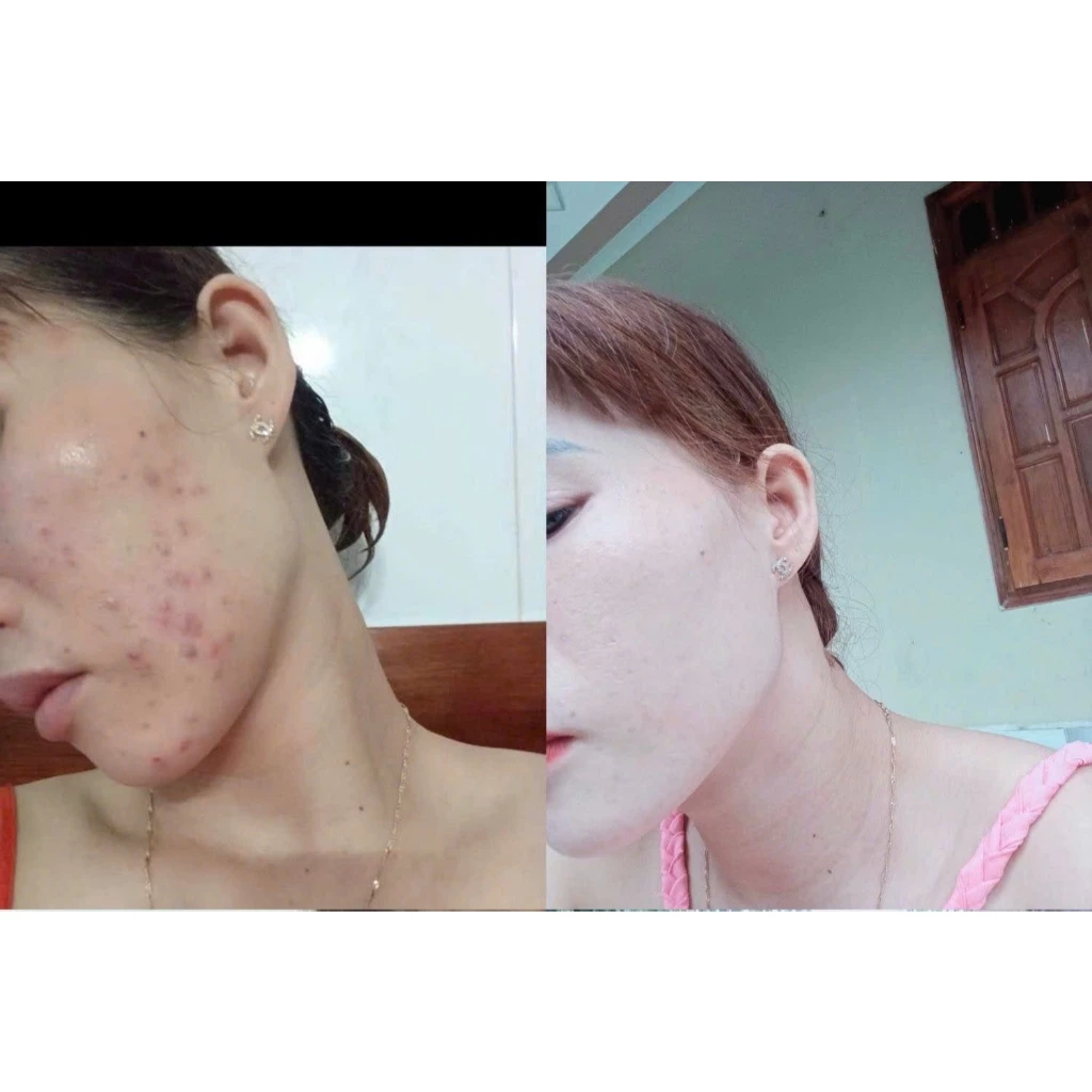 Combo xóa mụn thâm Detox Blanc (Serum Peel H và Sữa Rửa Mặt B5)