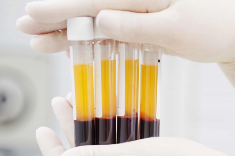 [HCM]Ống nghiệm ACD dùng lấy máu chân không trong PRP 85ml