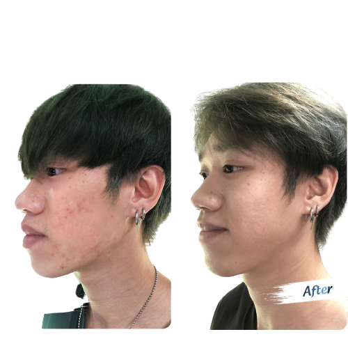 Kem mụn thảo dược Lori B - 10ml