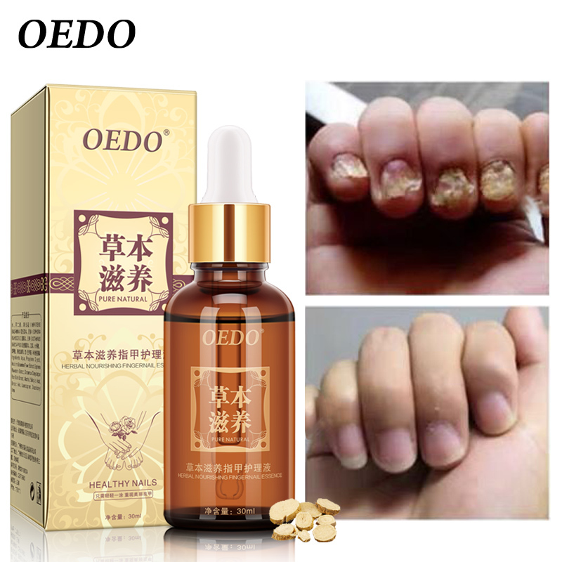 OEDO Tinh chất thiết yếu điều trị Nấm Thảo Dược làm trắng tay và chân móng chân loại bỏ nấm nhiễm trùng chăm sóc chân Serum
