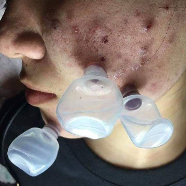 100 Ống nhựa Hút mụn viêm hút máu bầm , lọ chiết nhựa, lọ nhỏ mắt 5ml, 10ml kèm nút