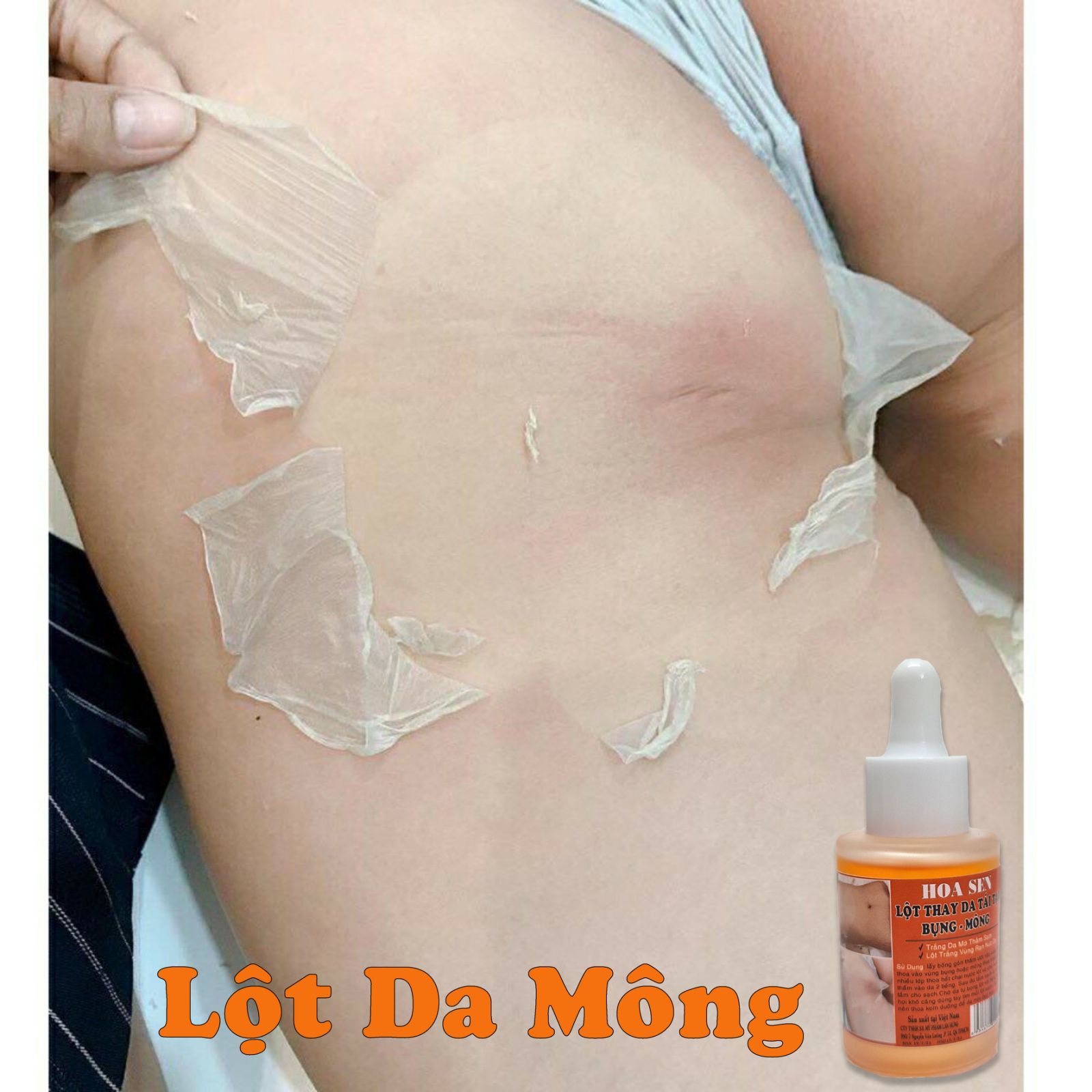 Lột Trắng Da Bụng Mông Bẹn Mờ Rạn Da Thâm Sạm
