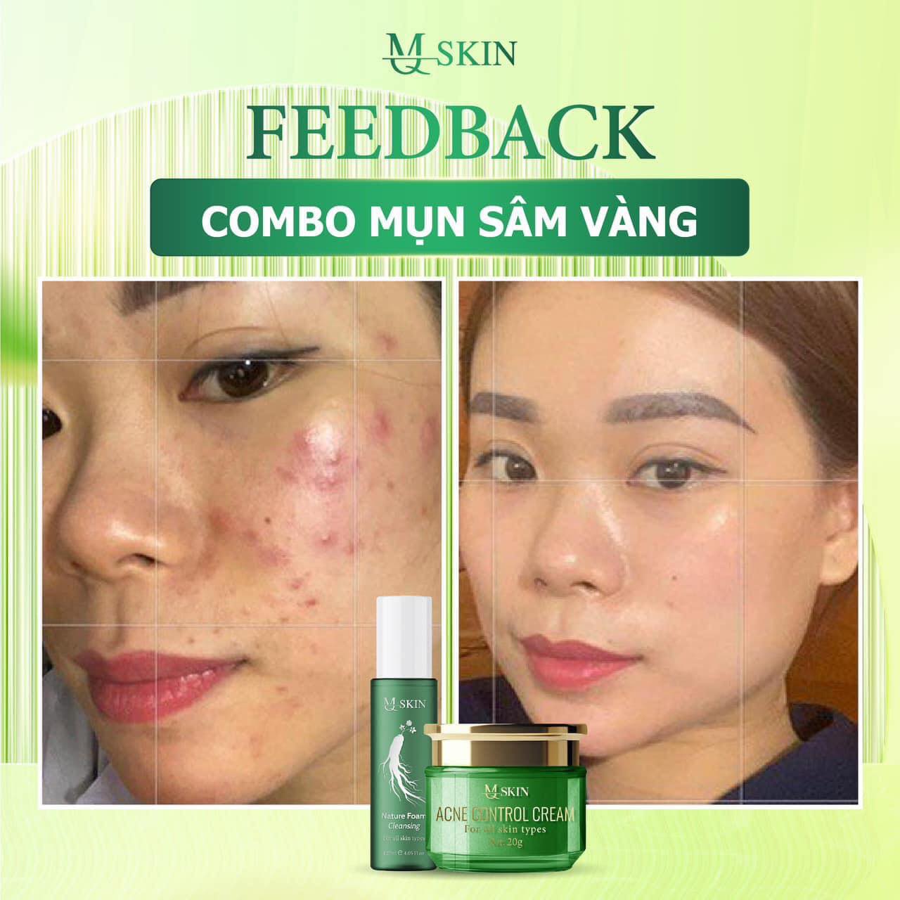 MQ Skin Acne Control Cream Combo for All Skin Types with Ginseng Extract