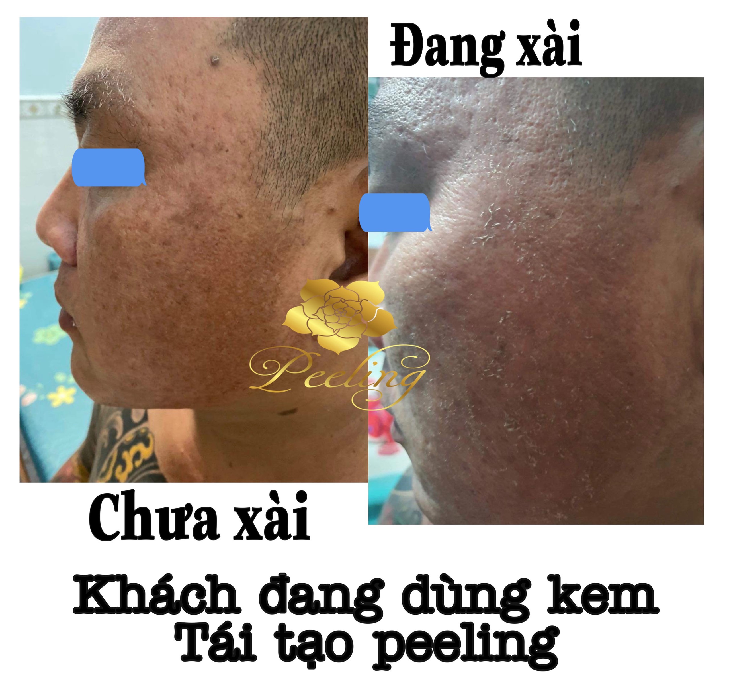 [HCM]5 Hộp Kem Peeling Tái Tạo Da