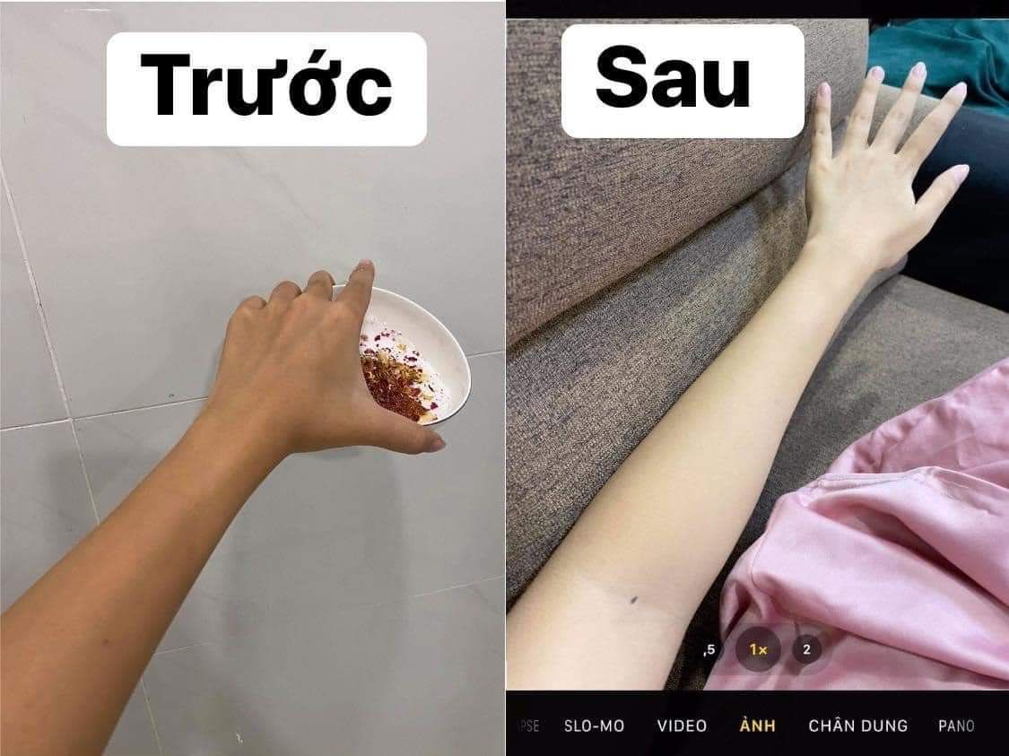 Liệu Trình 3 hộp Dành cho đen