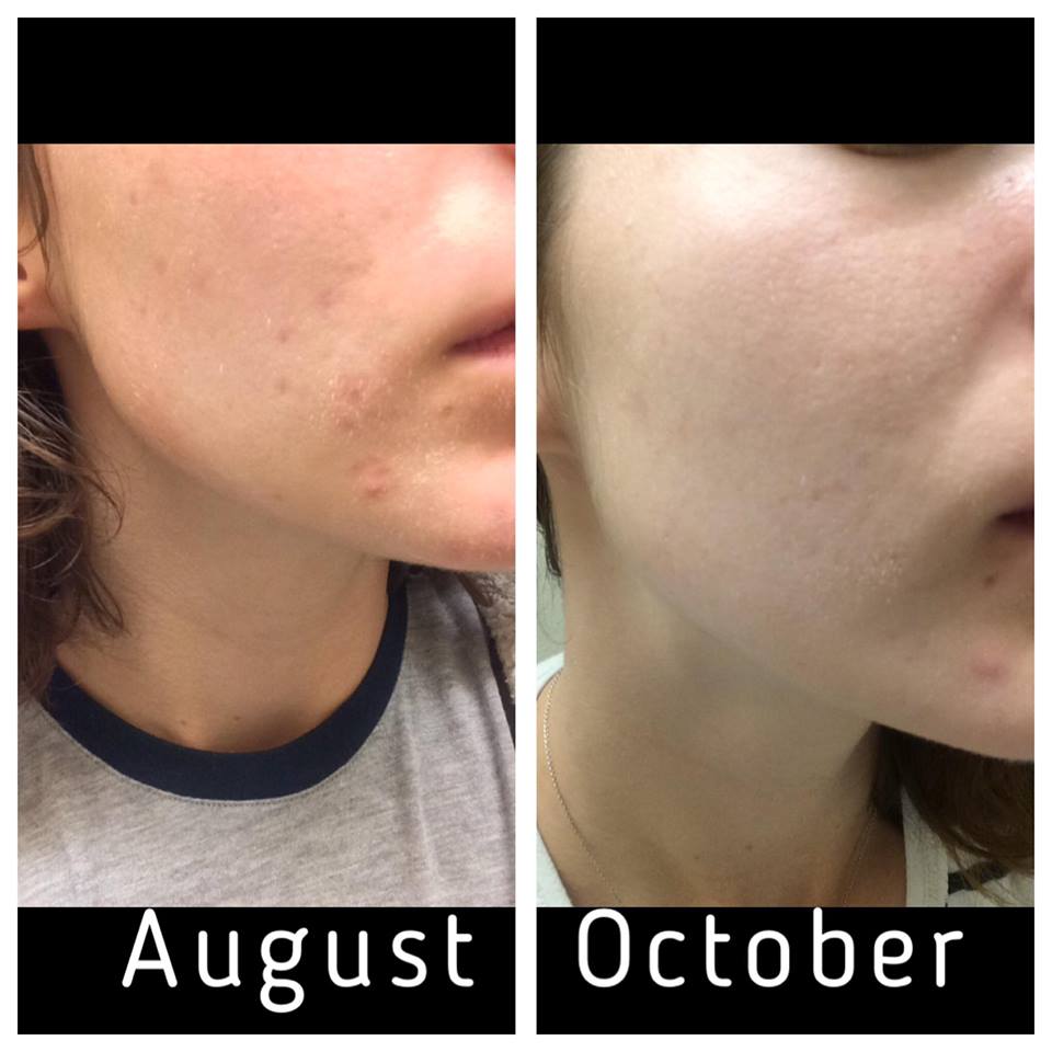 Serum Dưỡng Trắng The Ordinary Alpha Arbutin 2% + HA