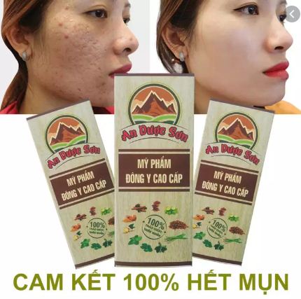 [HCM]Đánh Bay Sẹo Rổ Mụn Thâm Tàn Nhang An Dược Sơn 30ml - Giúp da trắng hơn mịn màng