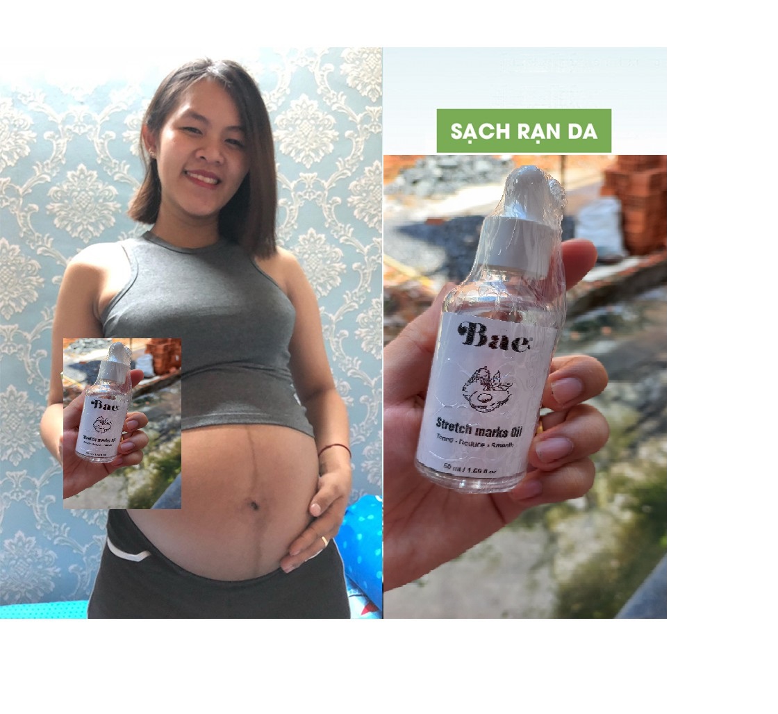 [HCM]Tinh Dầu ngăn ngừa rạn da cho bà bầu
