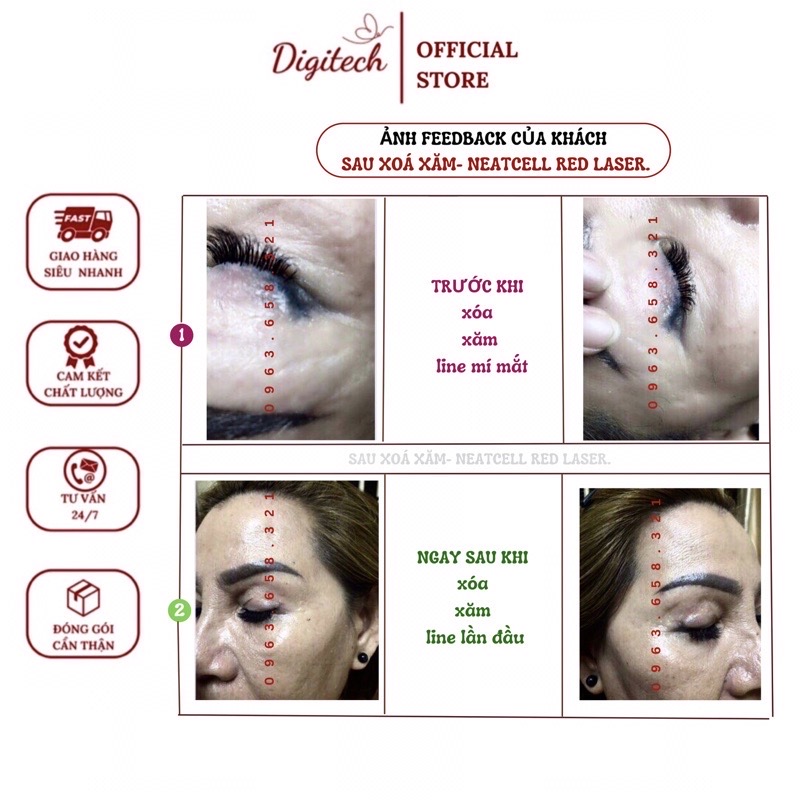 Máy xoá xăm chân mày NEATCELL- Lazer Đỏ