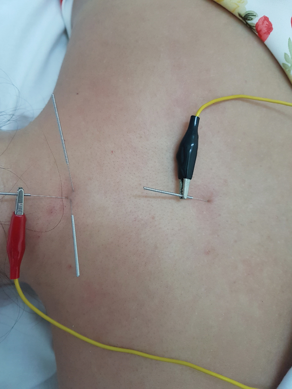 Máy châm cứu điện châm 12 kim 3 cọc tặng kèm 4 pin AA