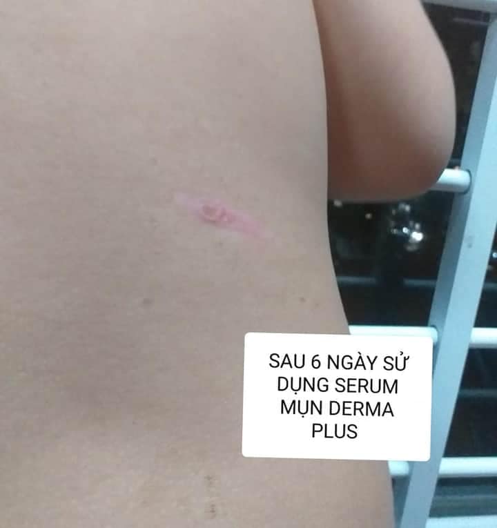 [HCM]SERUM MỤN DERMA PLUS