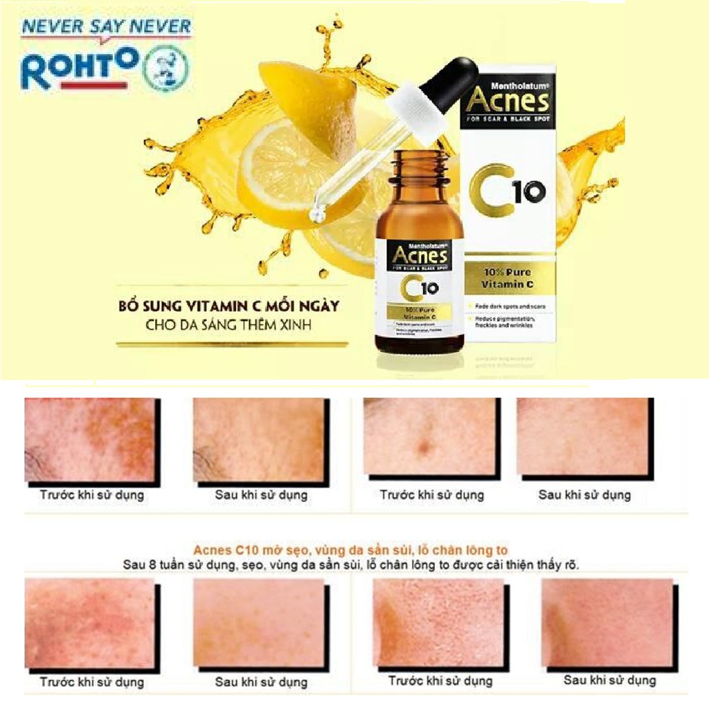 Serum Acnes Vitamin C Làm Mờ Sẹo & Vết Thâm 15ml For Scar & Black Spot Treatment C10 và C15