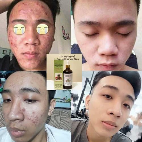 Compo 2 lọ Thảo Dược Sạch Mụn MT (100ml)
