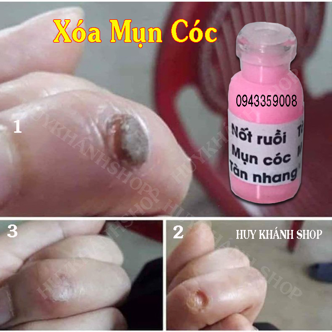 Tẩy Nốt Ruồi Tàn Nhang, Mắc Cá,Mụn Thịt, Mụn Cóc