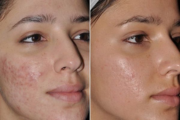 [HCM]Serum Giảm Mụn Mờ Thâm Macoizy Của Pháp