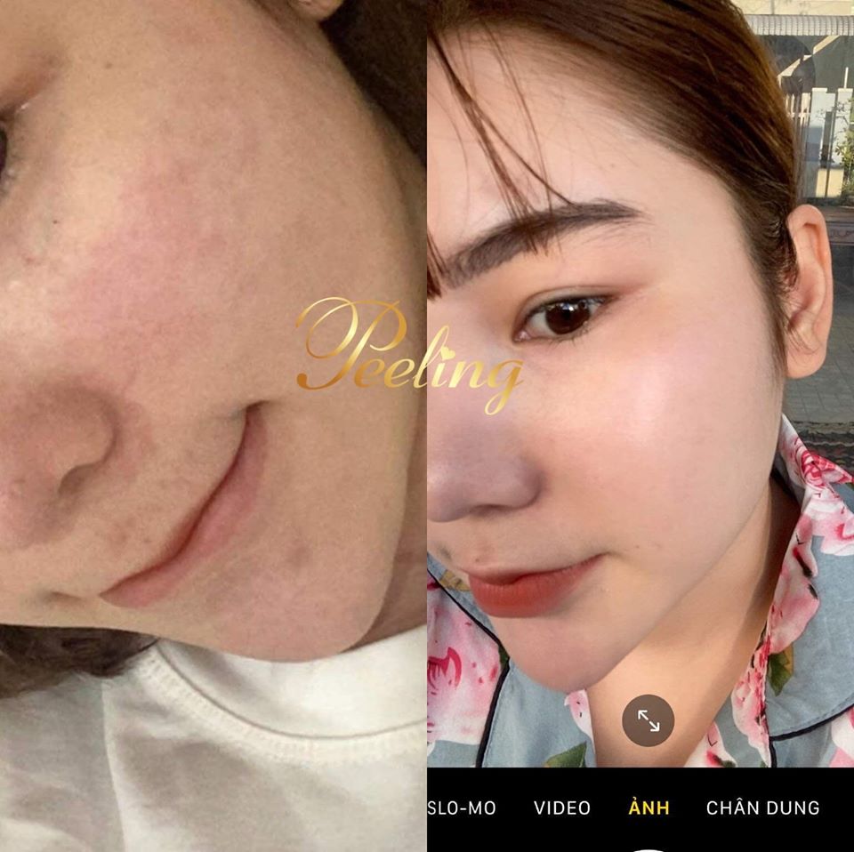 Kem Peeling Tái Tạo Da