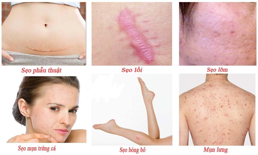 Kem mờ sẹo Nga Klirvin 25g mờ sẹo, mờ rạn da