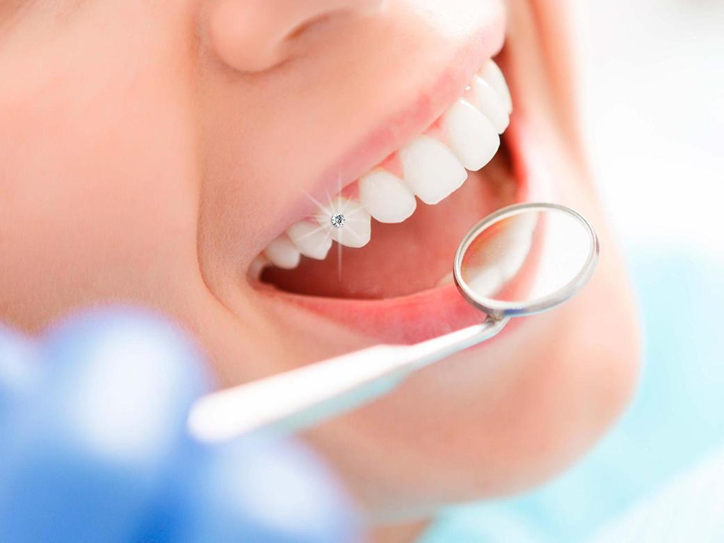 [HCM]hạt đính đá trên răng bộ 5 hạt + keo