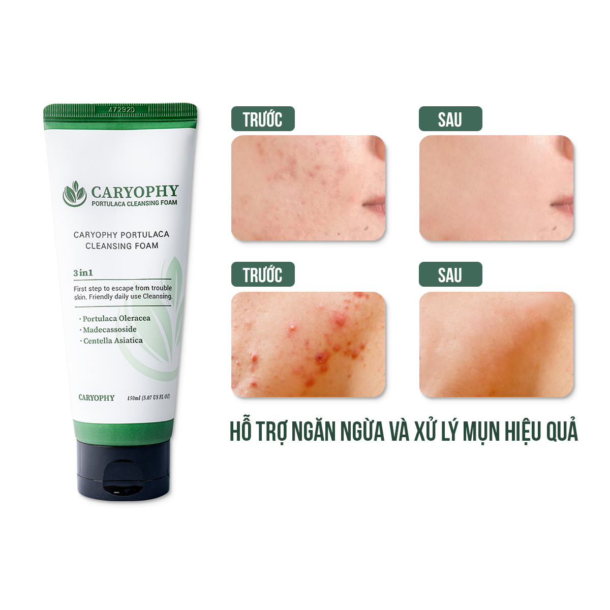 Combo giảm mụn mờ thâm sạch sâu Caryophy Portulaca (Serum giảm mụn 10ml - Toner không cồn 300ml - Sữa rửa mặt da mụn 150ml)