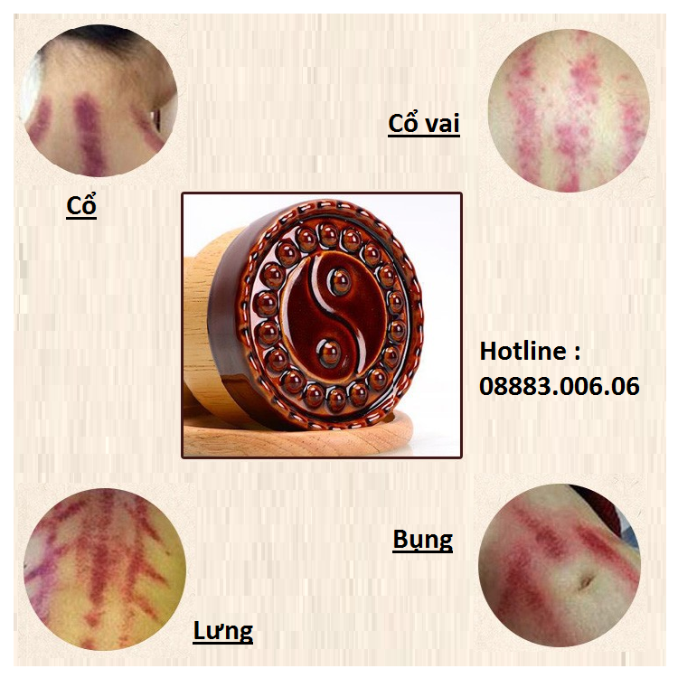 Cốc nhiệt trị liệu, cốc nhiệt massage spa